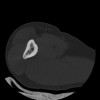 SPORK, NICO - 22.03.1976 - 02.08.2022 - CT obere Extremität - 17:59:38
